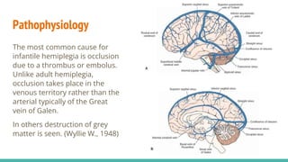 Pathophysiology
The most common cause for
infantile hemiplegia is occlusion
due to a thrombus or embolus.
Unlike adult hemiplegia,
occlusion takes place in the
venous territory rather than the
arterial typically of the Great
vein of Galen.
In others destruction of grey
matter is seen. (Wyllie W., 1948)
 