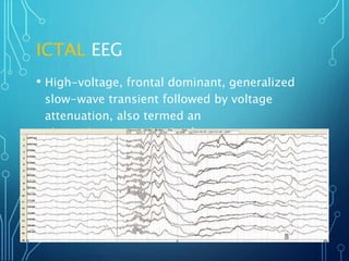 ICTAL EEG
• High-voltage, frontal dominant, generalized
slow-wave transient followed by voltage
attenuation, also termed an
electrodecremental episode
 