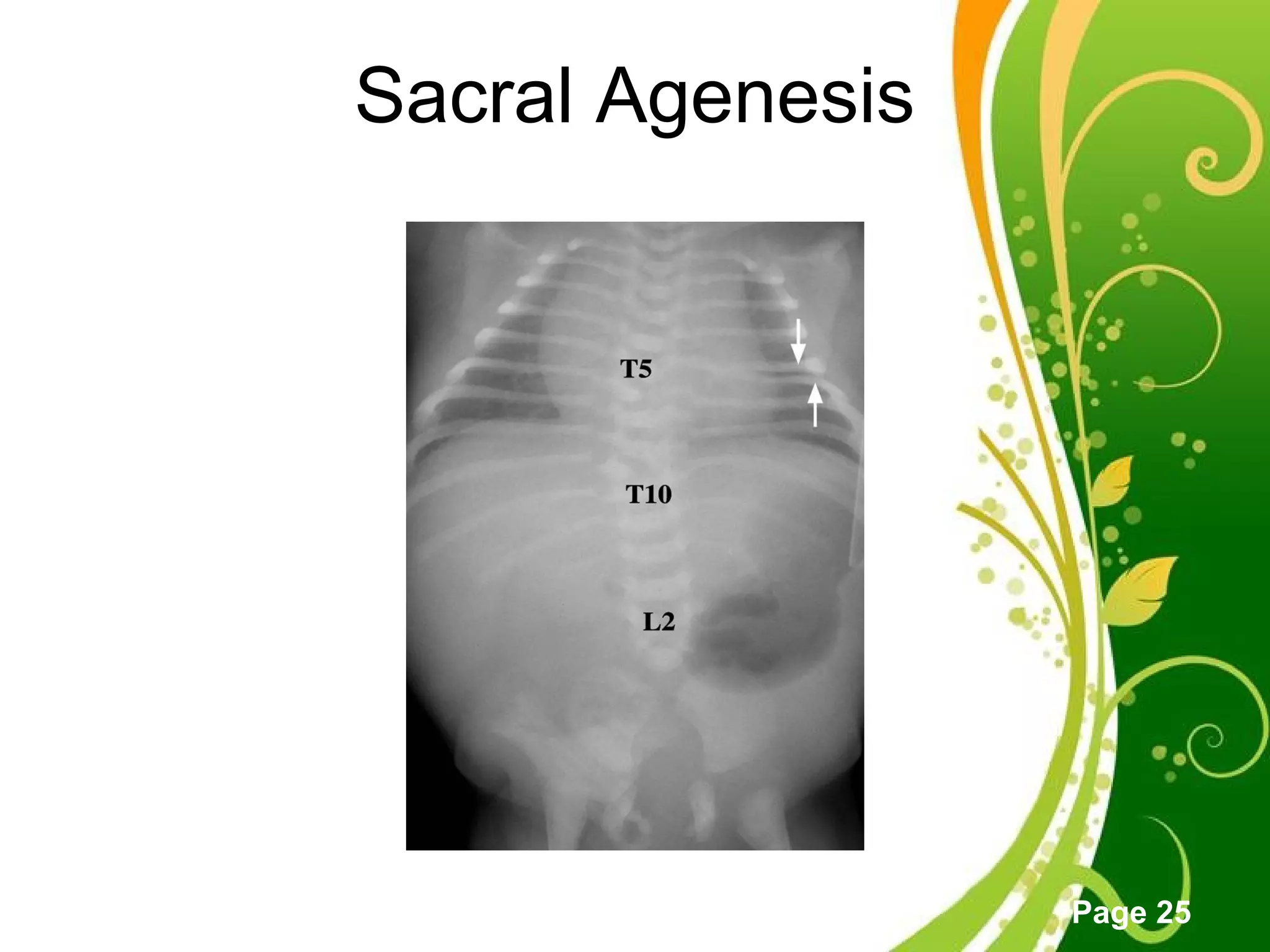 Click here to download this powerpoint template : Green Floral Free Powerpoint Template
For more : Powerpoint Template Presentations
Page 25
Sacral Agenesis
 