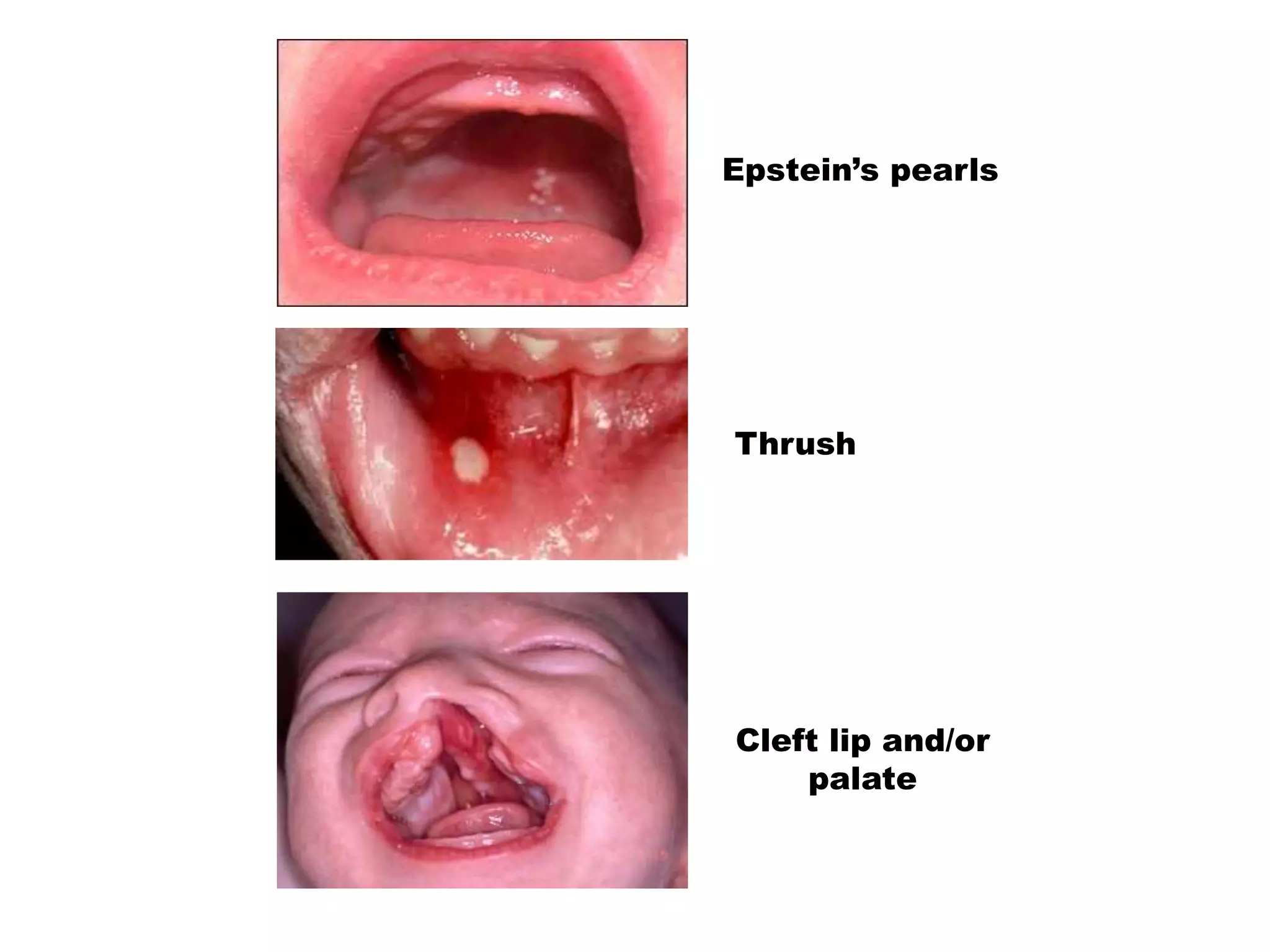 Thrush
Epstein’s pearls
Cleft lip and/or
palate
 