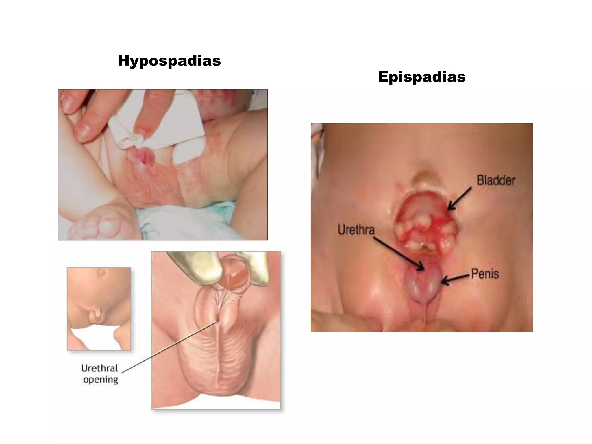 Hypospadias
Epispadias
 