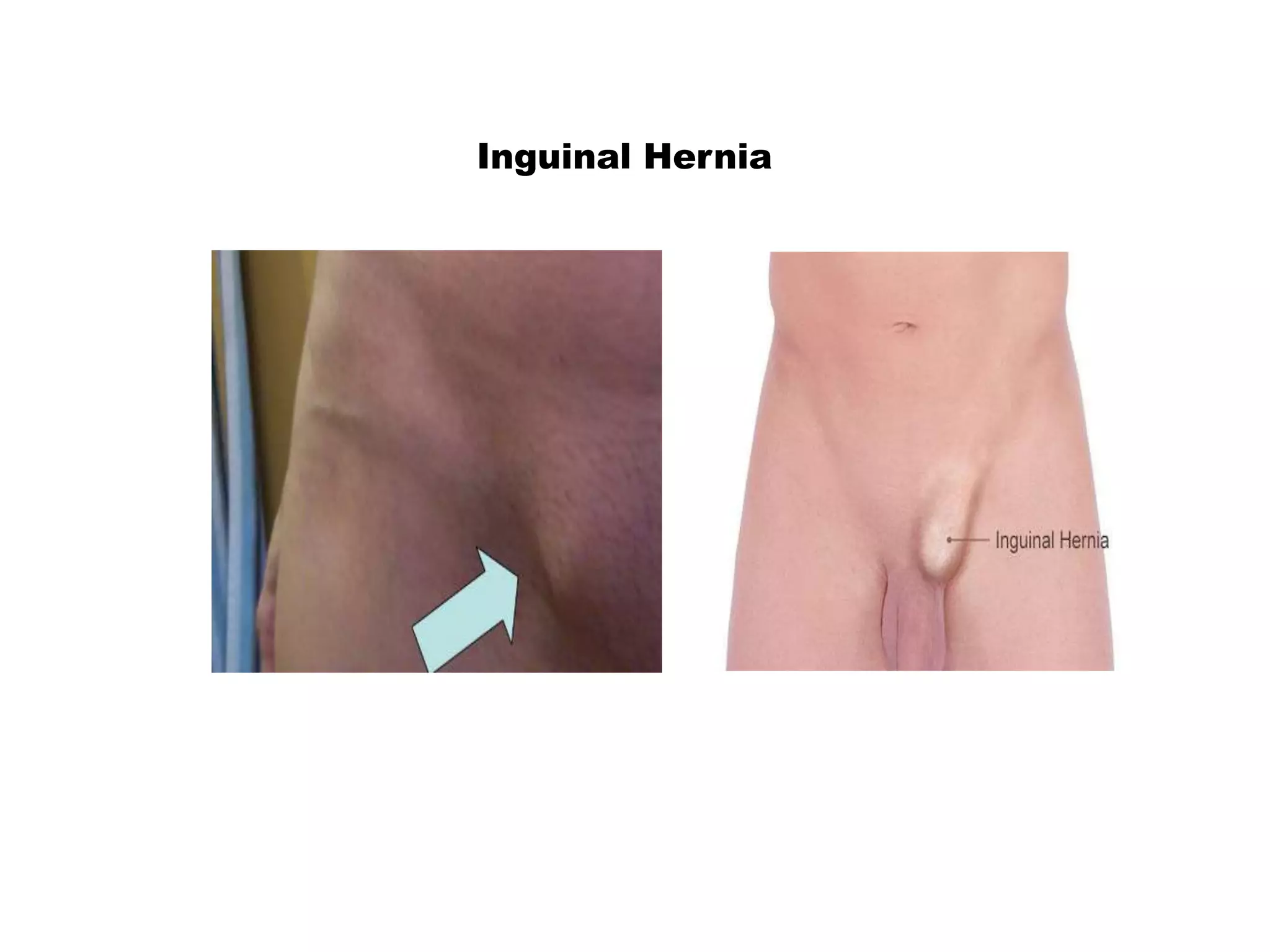 Inguinal Hernia
 