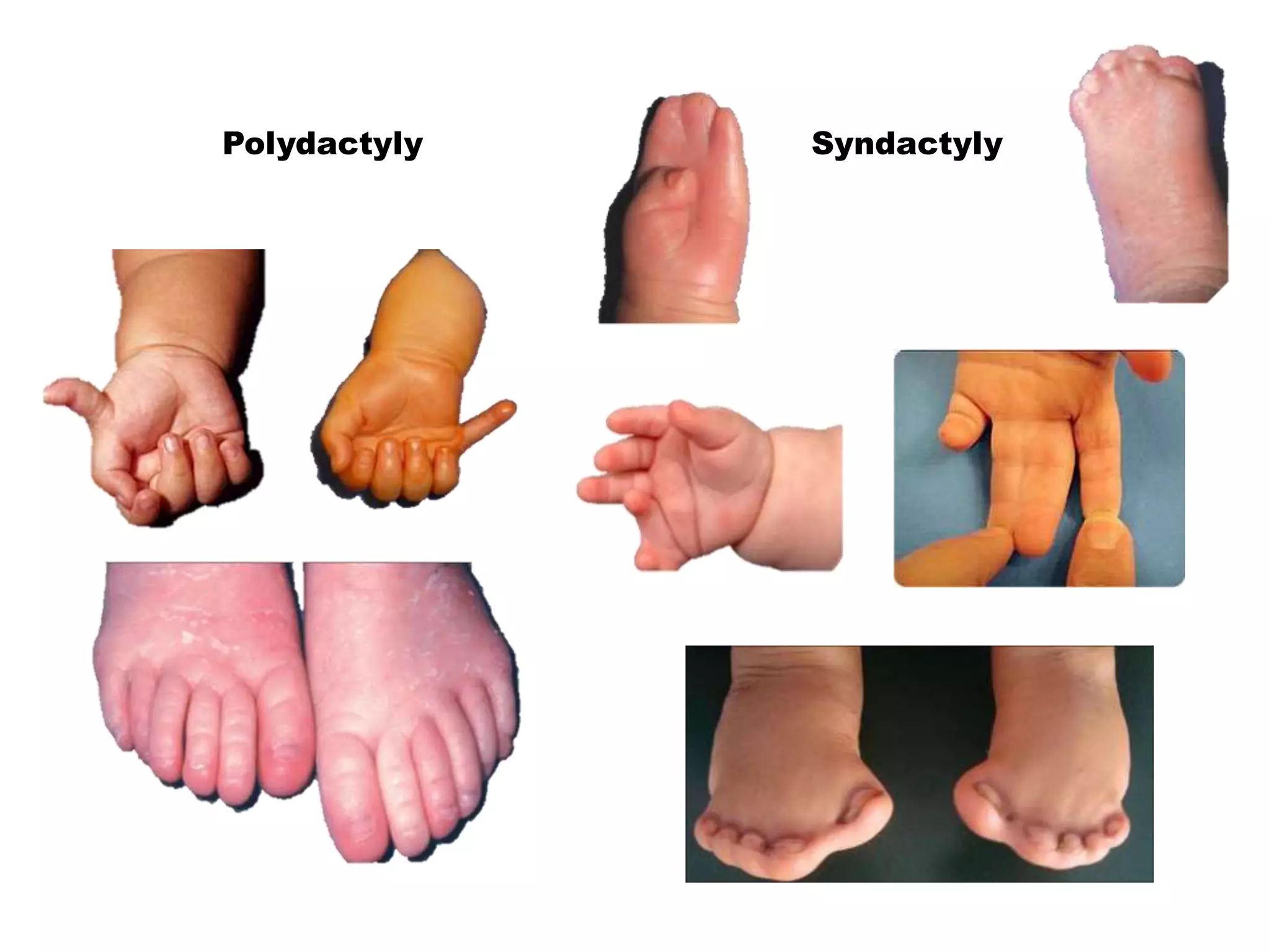 Polydactyly Syndactyly
 