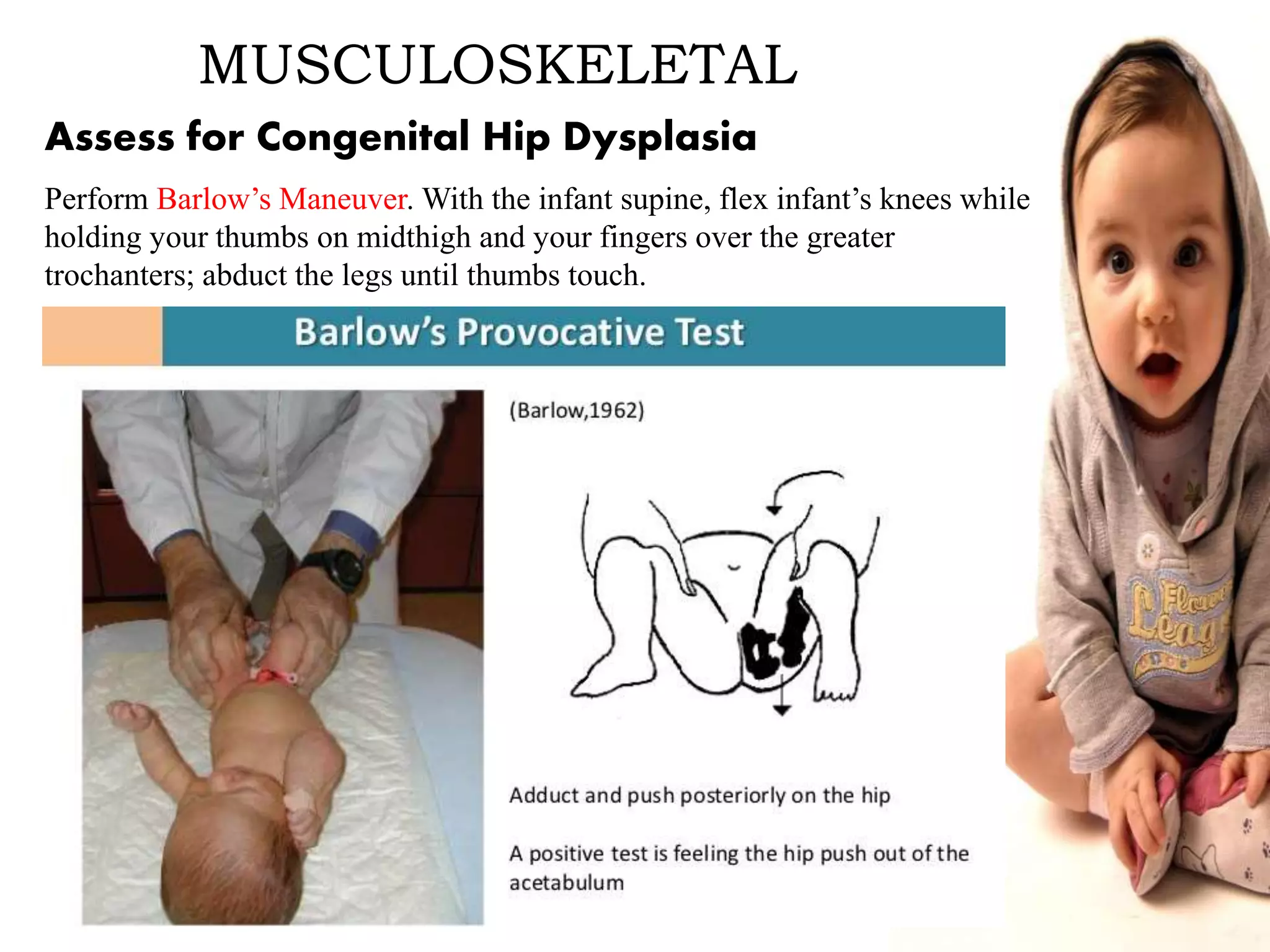 MUSCULOSKELETAL
Assess for Congenital Hip Dysplasia
Perform Barlow’s Maneuver. With the infant supine, flex infant’s knees while
holding your thumbs on midthigh and your fingers over the greater
trochanters; abduct the legs until thumbs touch.
 