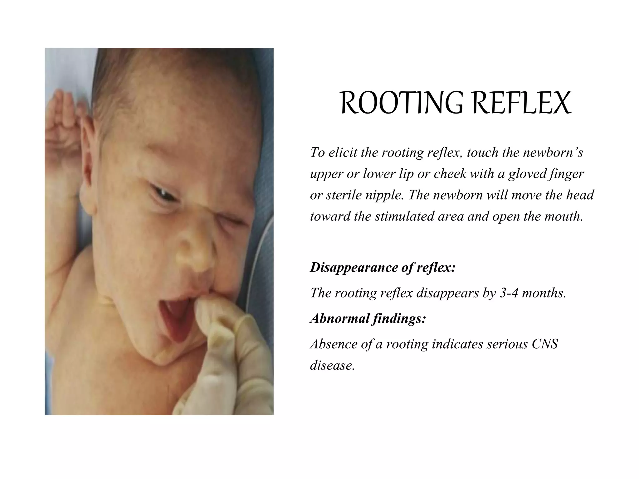 ROOTING REFLEX
To elicit the rooting reflex, touch the newborn’s
upper or lower lip or cheek with a gloved finger
or sterile nipple. The newborn will move the head
toward the stimulated area and open the mouth.
Disappearance of reflex:
The rooting reflex disappears by 3-4 months.
Abnormal findings:
Absence of a rooting indicates serious CNS
disease.
 