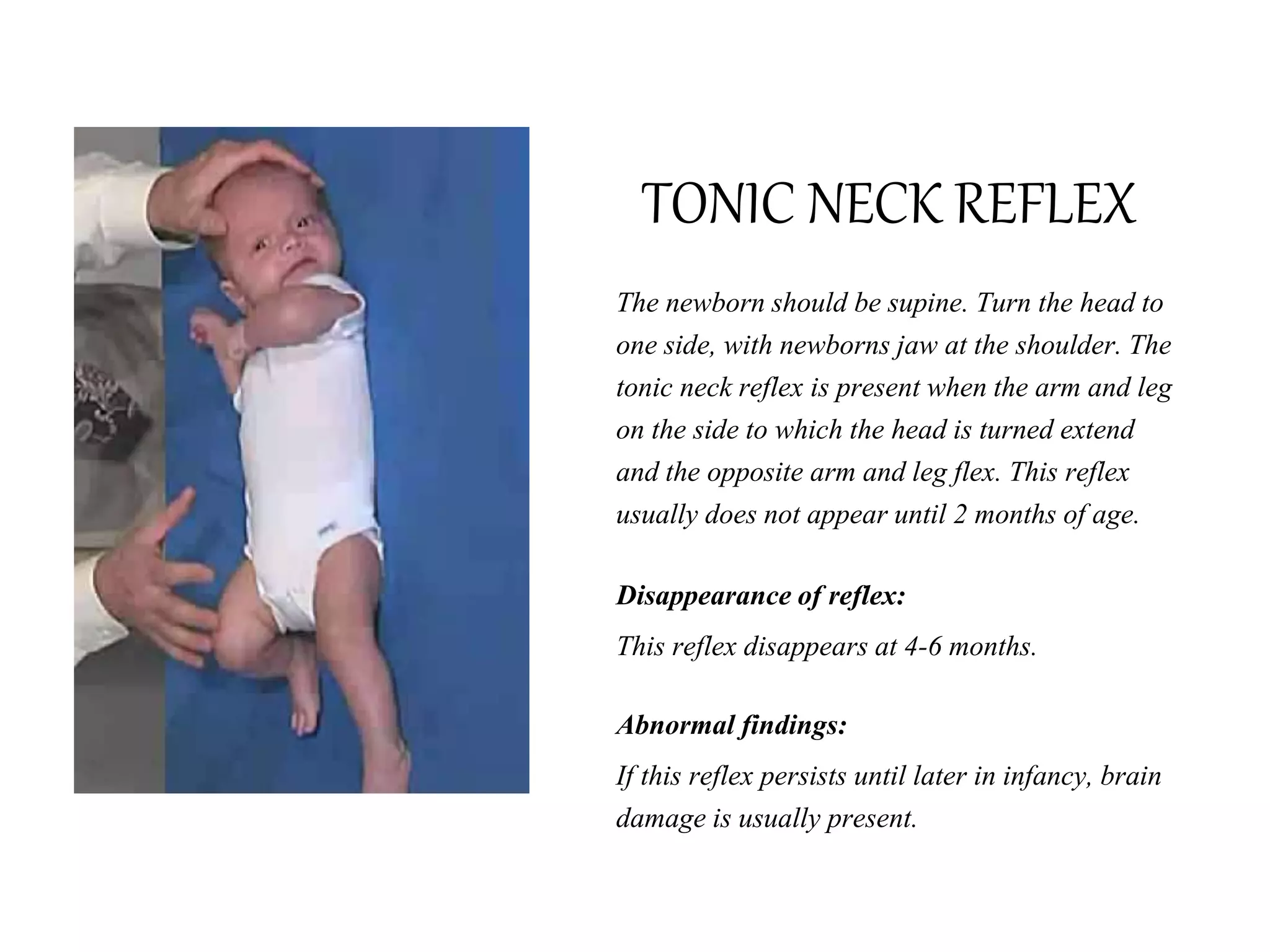 TONIC NECK REFLEX
The newborn should be supine. Turn the head to
one side, with newborns jaw at the shoulder. The
tonic neck reflex is present when the arm and leg
on the side to which the head is turned extend
and the opposite arm and leg flex. This reflex
usually does not appear until 2 months of age.
Disappearance of reflex:
This reflex disappears at 4-6 months.
Abnormal findings:
If this reflex persists until later in infancy, brain
damage is usually present.
 