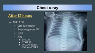 Infant respiratory distress syndrome PPV guideline