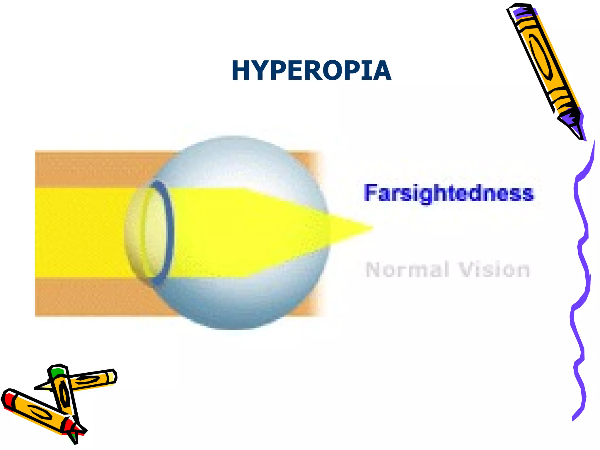 focused correctly.                                                                       Common signs of farsightedness include difficulty in concentrating and maintaining a clear focus on near objects, eye strain, fatigue and/or headaches after close work, aching or burning eyes, irritability or  HYPEROPIA  