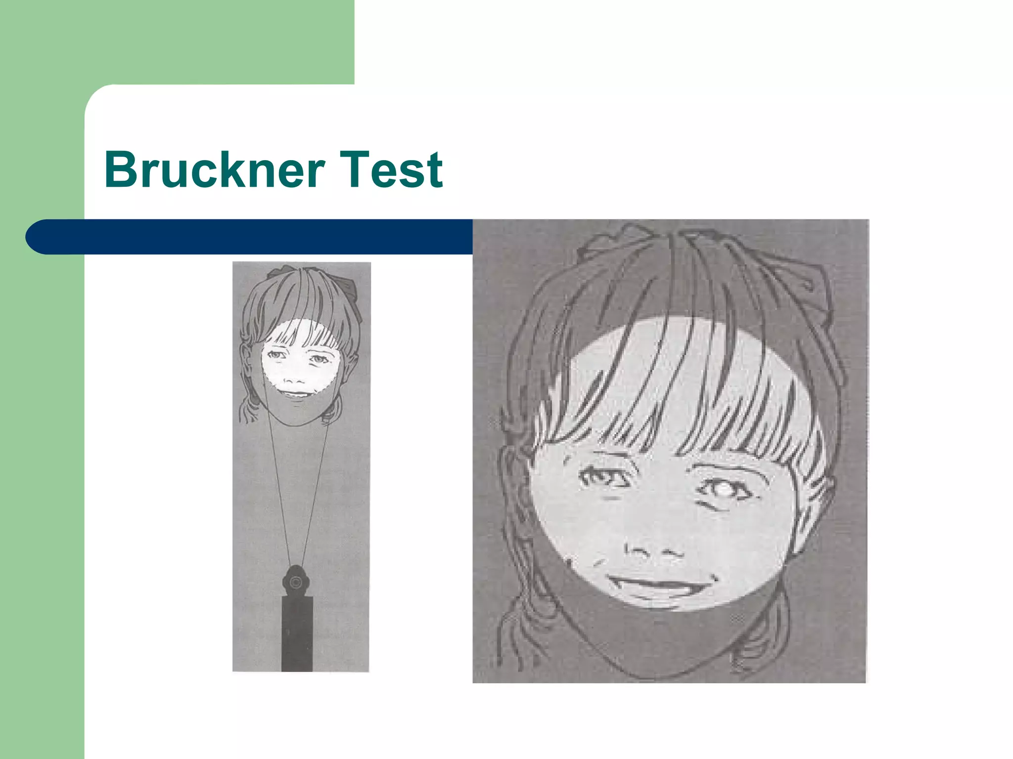 Bruckner Test 