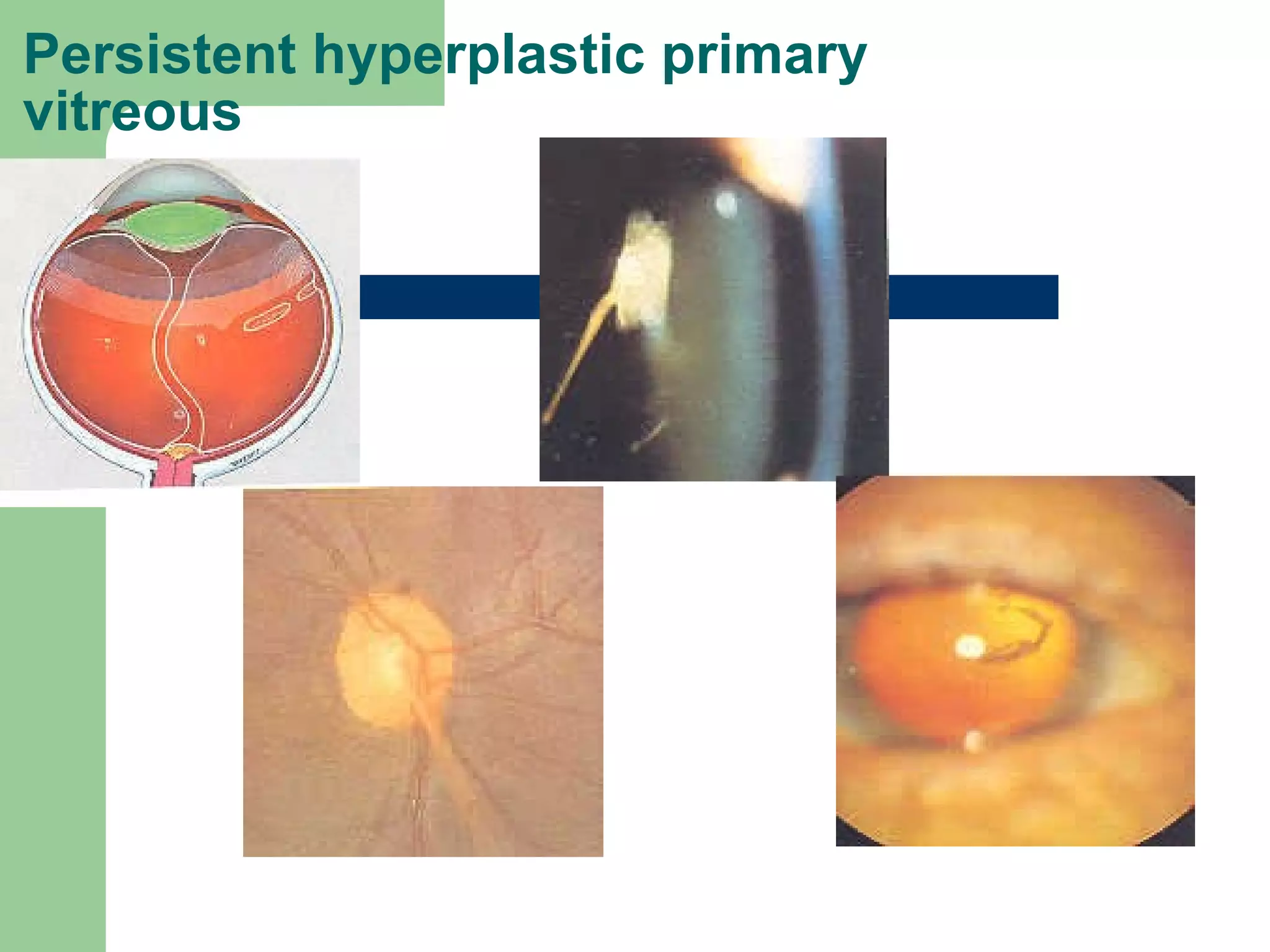 Persistent hyperplastic primary vitreous  
