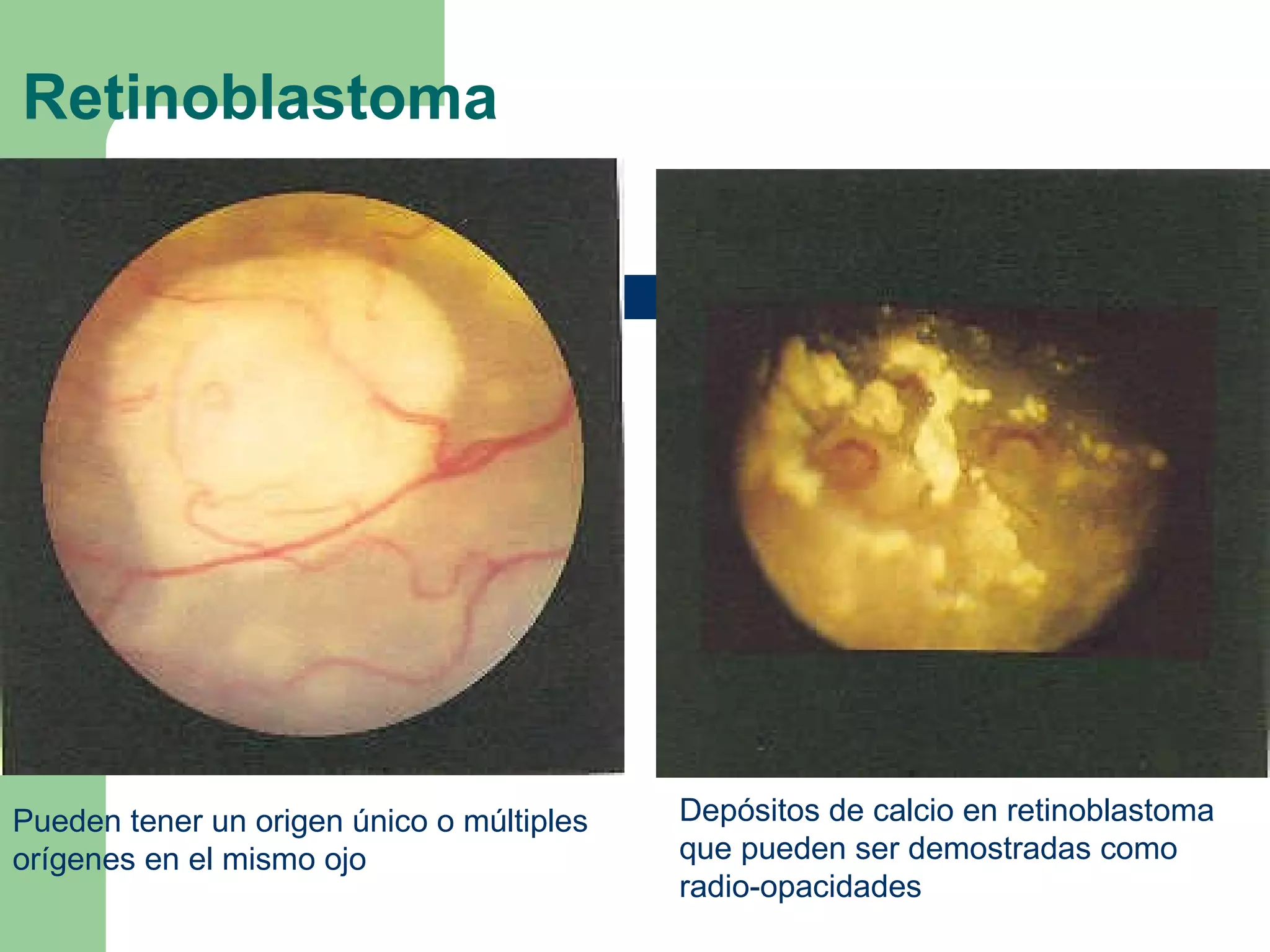 Retinoblastoma Depósitos de calcio en retinoblastoma que pueden ser demostradas como radio-opacidades Pueden tener un origen único o múltiples orígenes en el mismo ojo 