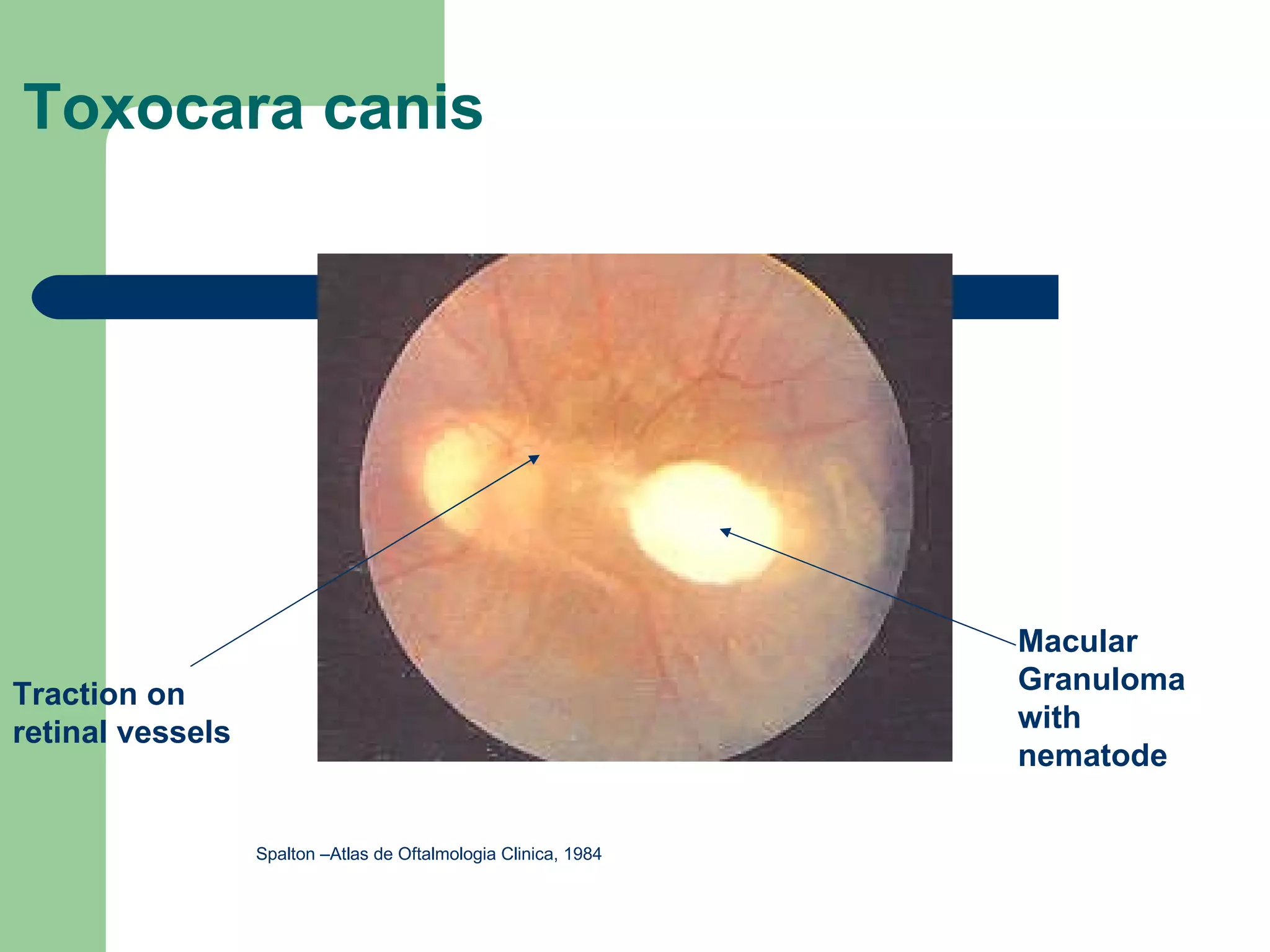 Toxocara canis Traction on retinal vessels Macular Granuloma with nematode Spalton –Atlas de Oftalmologia Clinica, 1984 