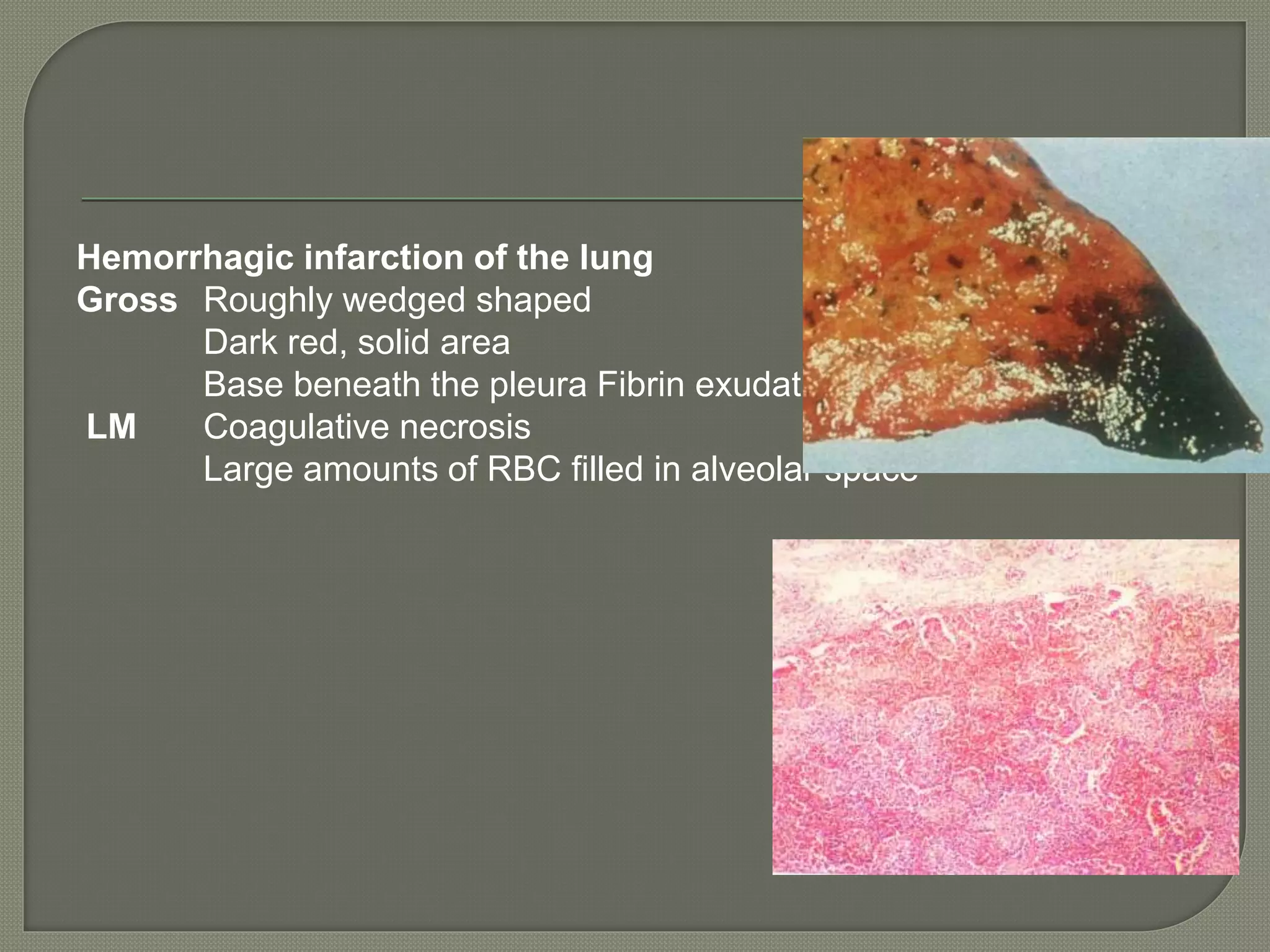 Hemorrhagic infarction of the lung
Gross Roughly wedged shaped
Dark red, solid area
Base beneath the pleura Fibrin exudation
LM Coagulative necrosis
Large amounts of RBC filled in alveolar space