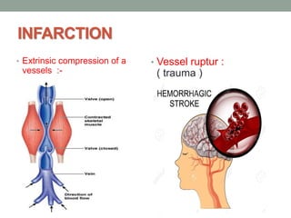 INFARCTION | PDF