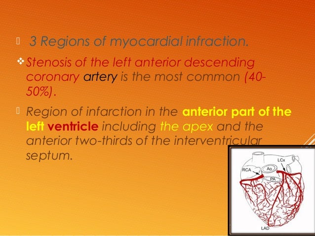 Infarction