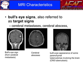 Infarction and some important lesions mimicking brain tumour | PPT