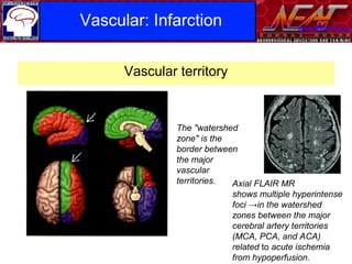 Infarction and some important lesions mimicking brain tumour | PPT