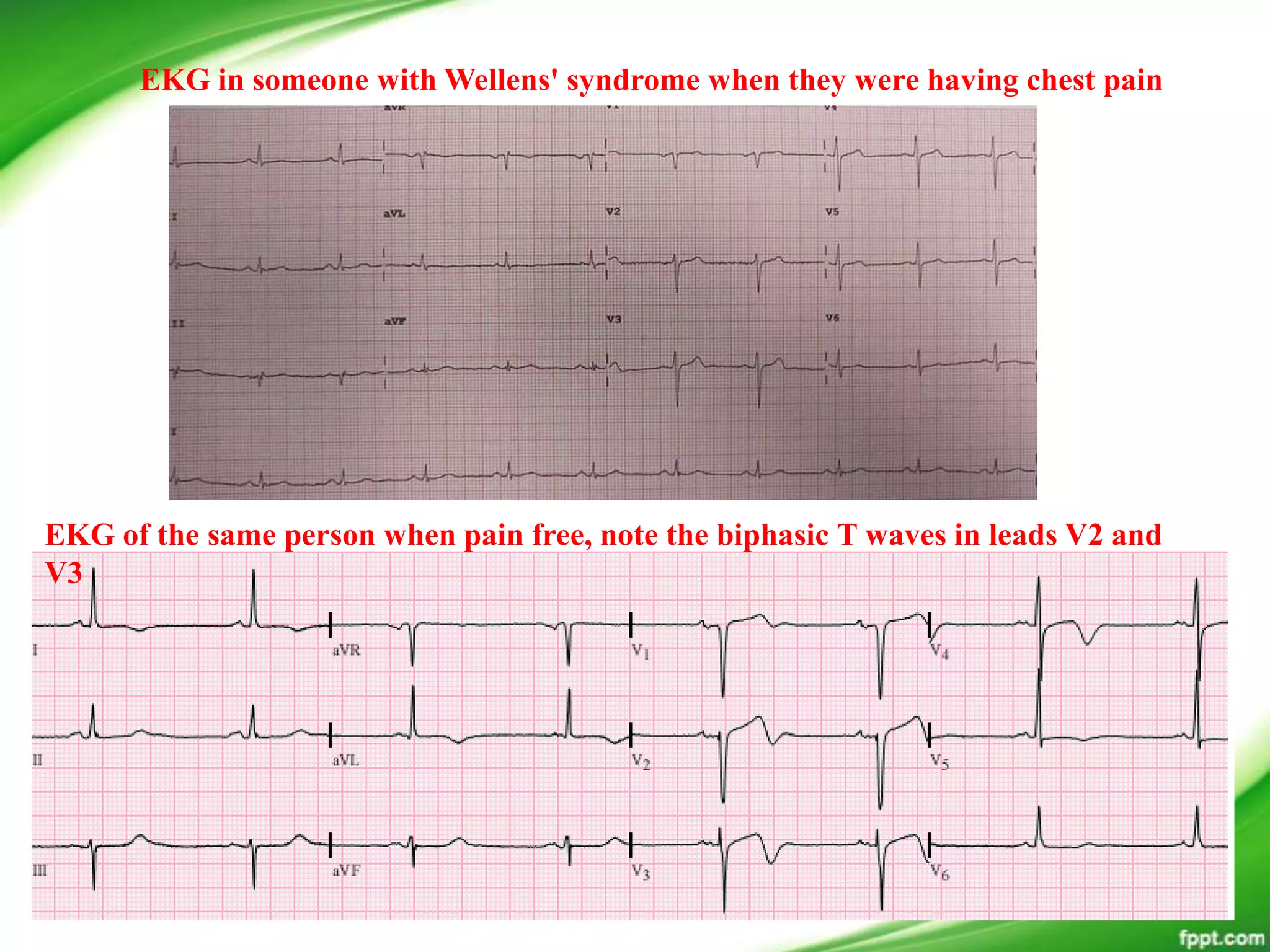 EKG in someone with Wellens' syndrome when they were having chest pain
EKG of the same person when pain free, note the biphasic T waves in leads V2 and
V3
 
