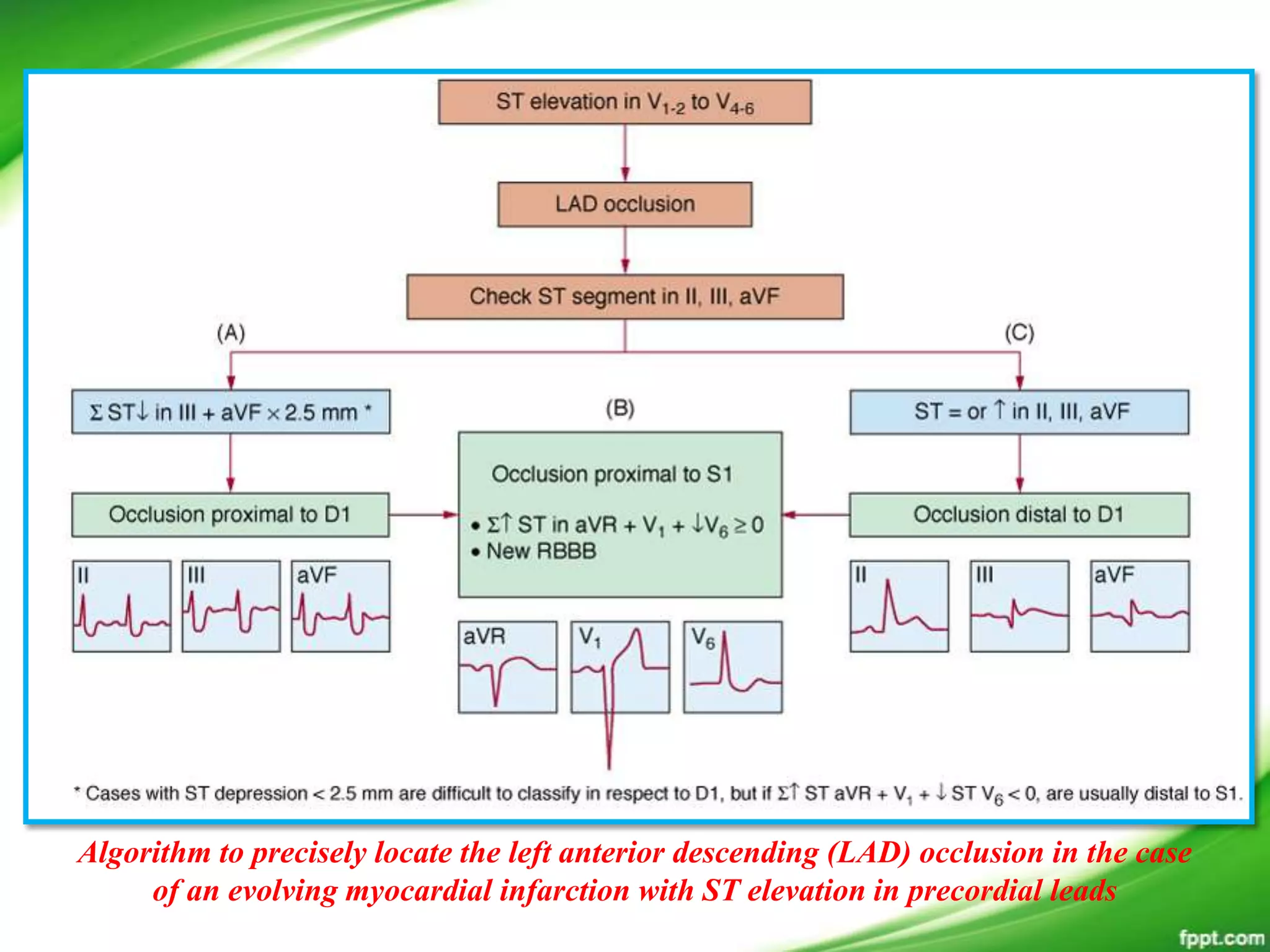 Algorithm to precisely locate the left anterior descending (LAD) occlusion in the case
of an evolving myocardial infarction with ST elevation in precordial leads
 