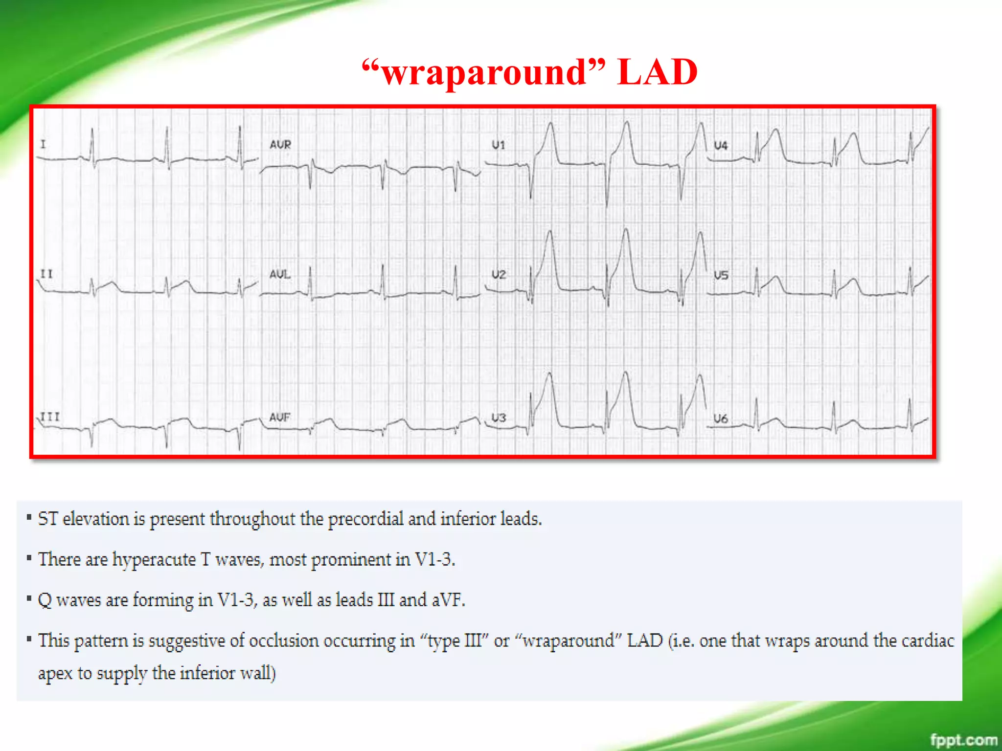 “wraparound” LAD
 
