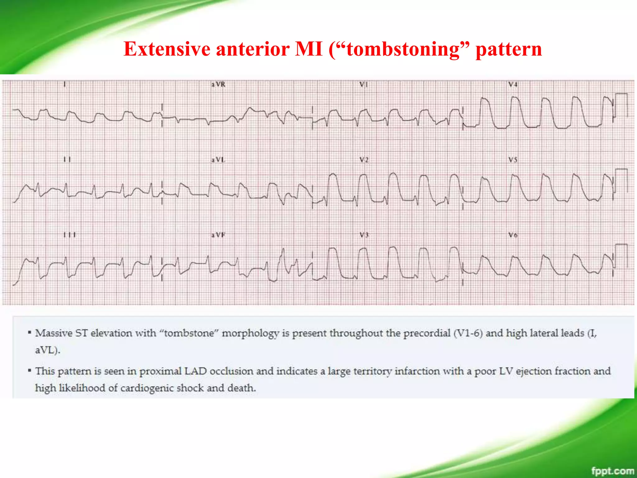 Extensive anterior MI (“tombstoning” pattern
 