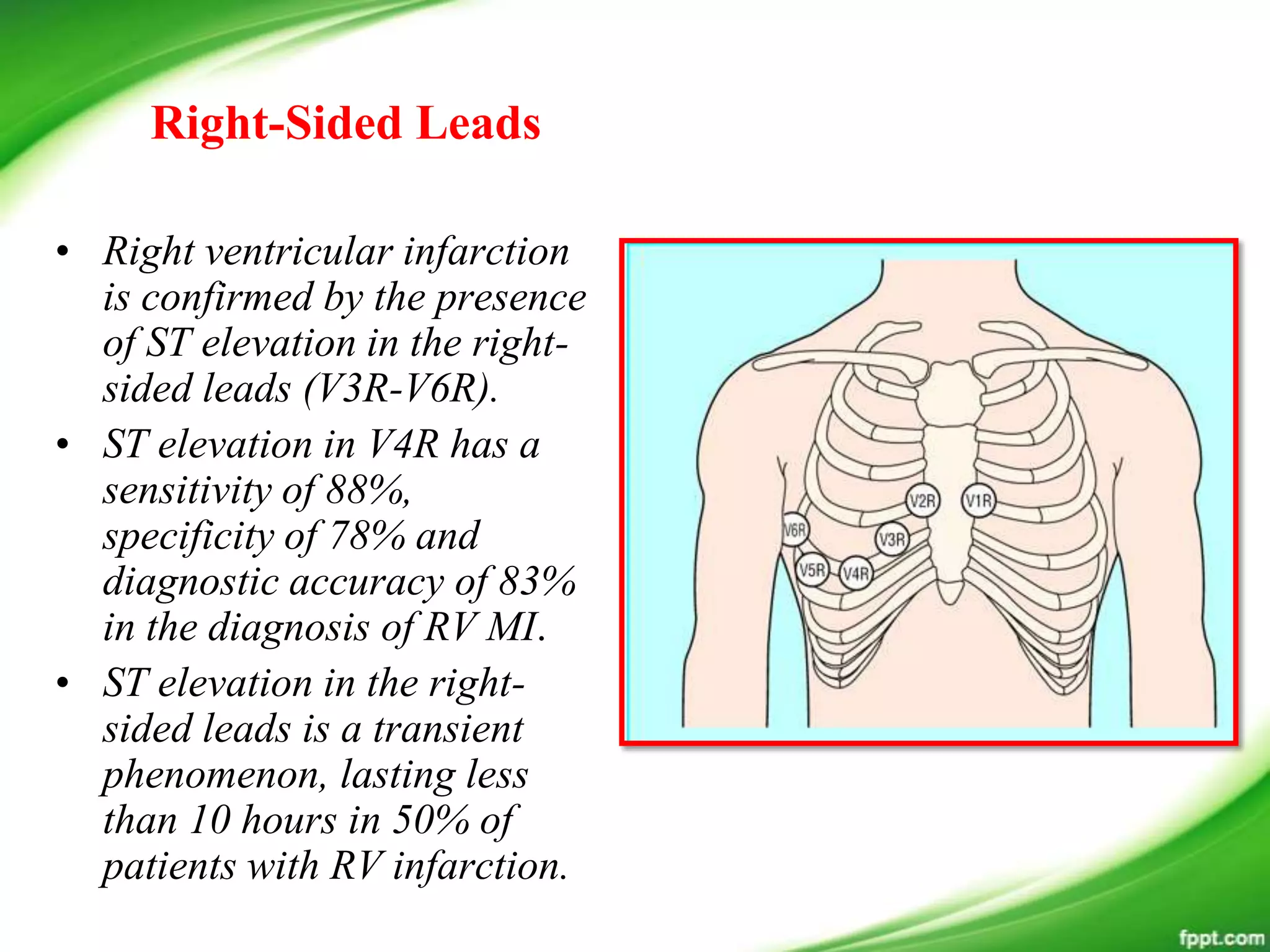 • Right ventricular infarction
is confirmed by the presence
of ST elevation in the right-
sided leads (V3R-V6R).
• ST elevation in V4R has a
sensitivity of 88%,
specificity of 78% and
diagnostic accuracy of 83%
in the diagnosis of RV MI.
• ST elevation in the right-
sided leads is a transient
phenomenon, lasting less
than 10 hours in 50% of
patients with RV infarction.
Right-Sided Leads
 