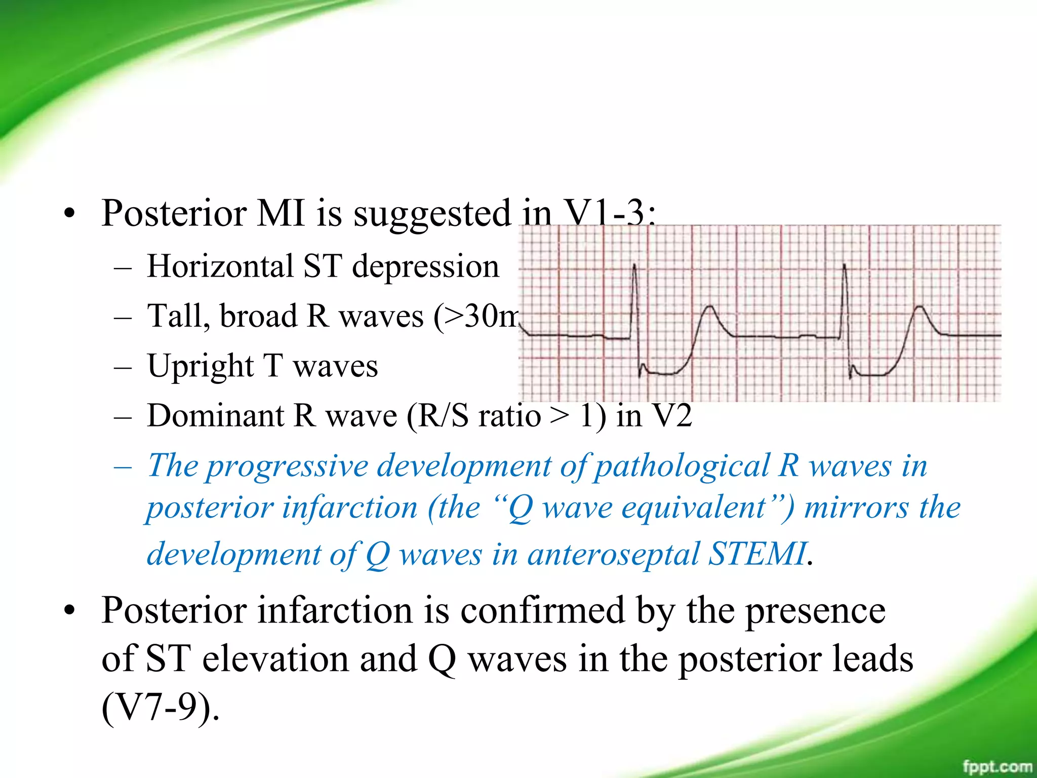 • Posterior MI is suggested in V1-3:
– Horizontal ST depression
– Tall, broad R waves (>30ms)
– Upright T waves
– Dominant R wave (R/S ratio > 1) in V2
– The progressive development of pathological R waves in
posterior infarction (the “Q wave equivalent”) mirrors the
development of Q waves in anteroseptal STEMI.
• Posterior infarction is confirmed by the presence
of ST elevation and Q waves in the posterior leads
(V7-9).
 