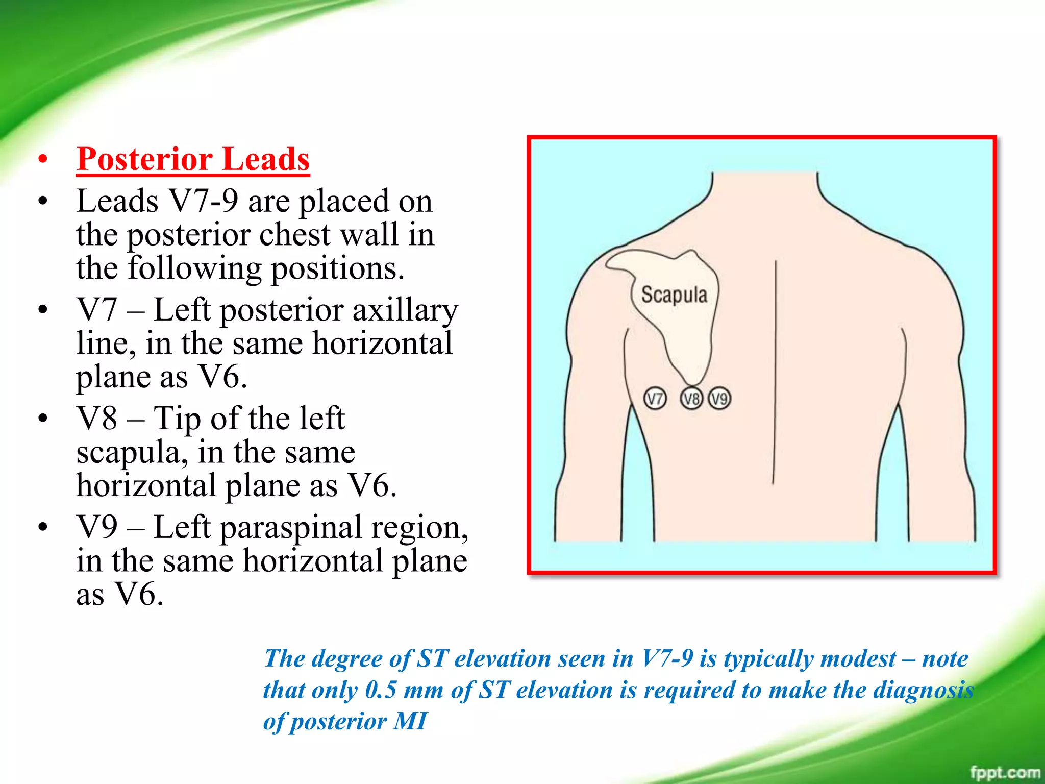 • Posterior Leads
• Leads V7-9 are placed on
the posterior chest wall in
the following positions.
• V7 – Left posterior axillary
line, in the same horizontal
plane as V6.
• V8 – Tip of the left
scapula, in the same
horizontal plane as V6.
• V9 – Left paraspinal region,
in the same horizontal plane
as V6.
The degree of ST elevation seen in V7-9 is typically modest – note
that only 0.5 mm of ST elevation is required to make the diagnosis
of posterior MI
 