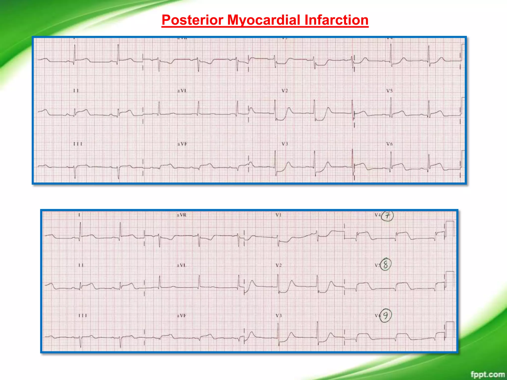 Posterior Myocardial Infarction
 
