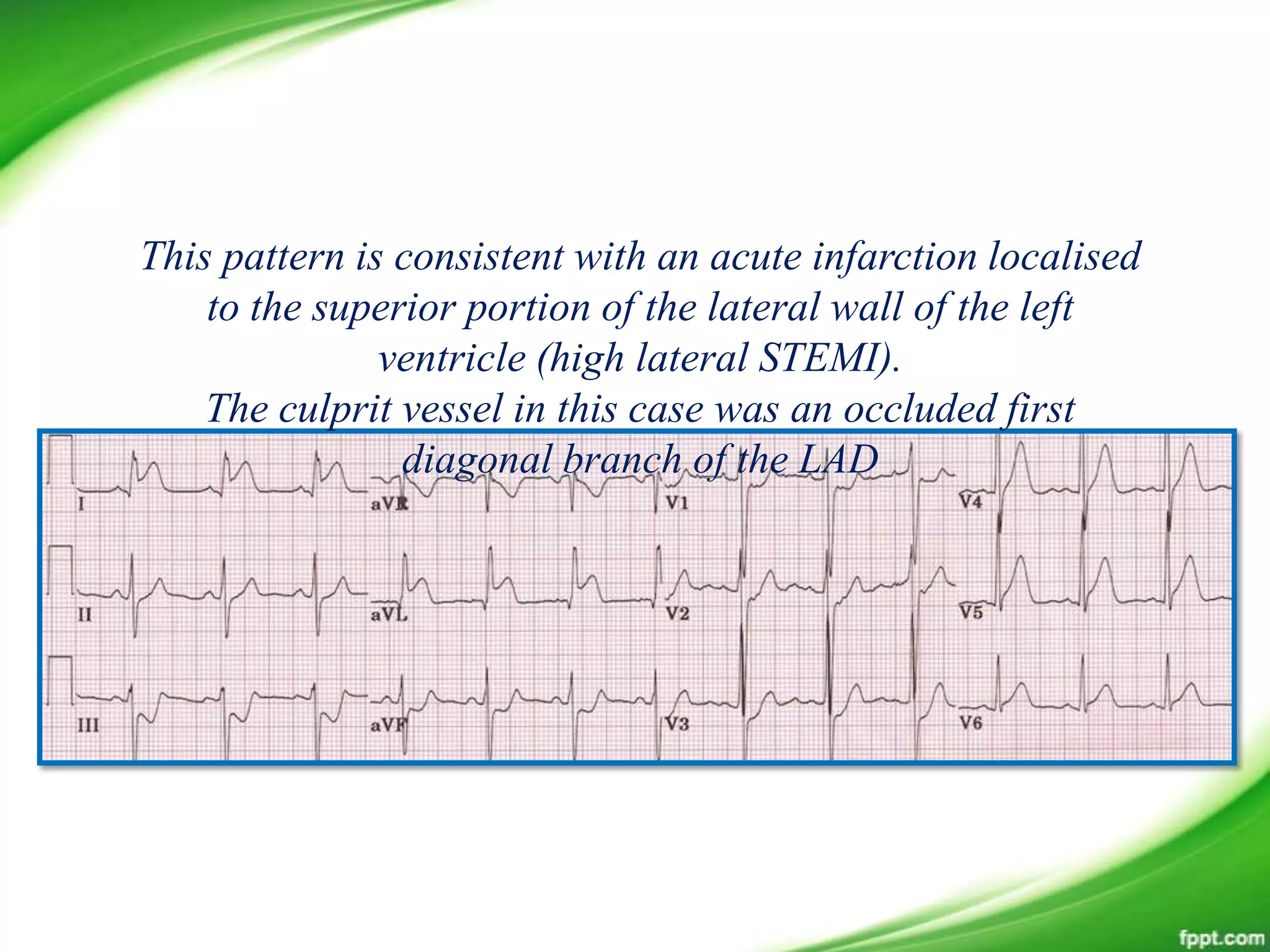 This pattern is consistent with an acute infarction localised
to the superior portion of the lateral wall of the left
ventricle (high lateral STEMI).
The culprit vessel in this case was an occluded first
diagonal branch of the LAD
 