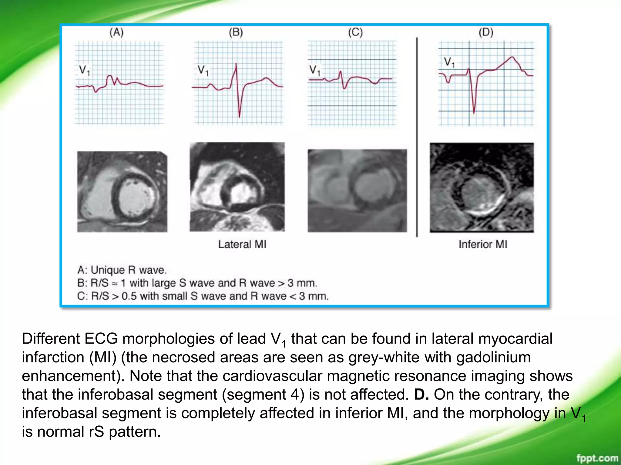 Different ECG morphologies of lead V1 that can be found in lateral myocardial
infarction (MI) (the necrosed areas are seen as grey-white with gadolinium
enhancement). Note that the cardiovascular magnetic resonance imaging shows
that the inferobasal segment (segment 4) is not affected. D. On the contrary, the
inferobasal segment is completely affected in inferior MI, and the morphology in V1
is normal rS pattern.
 