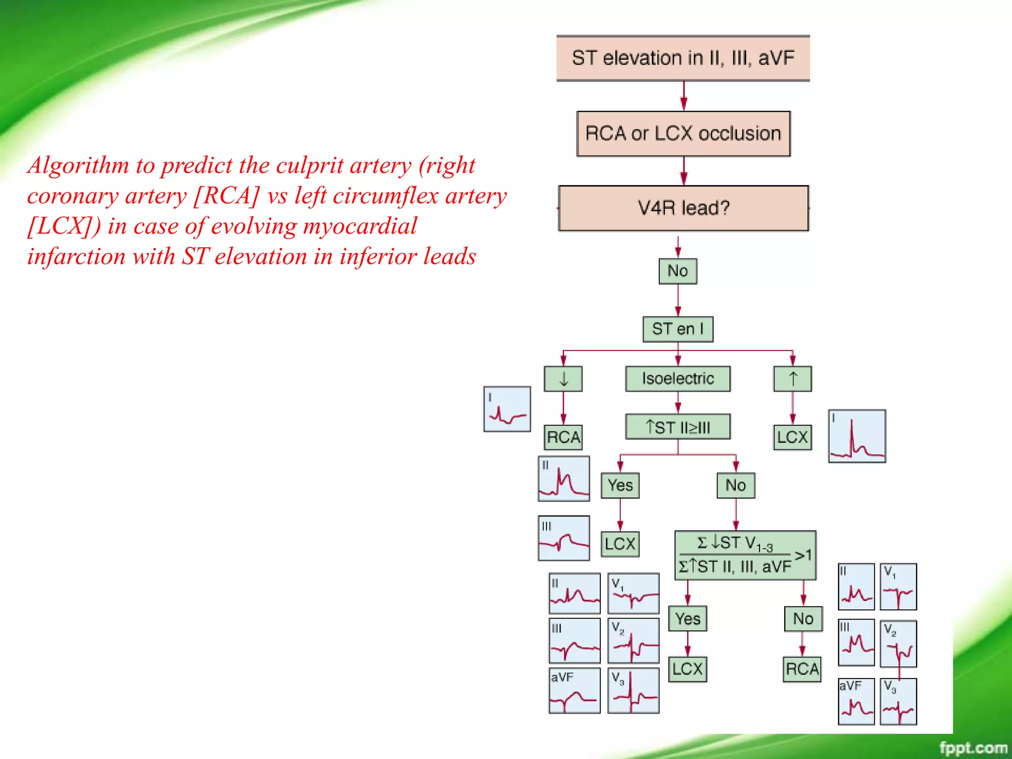 Algorithm to predict the culprit artery (right
coronary artery [RCA] vs left circumflex artery
[LCX]) in case of evolving myocardial
infarction with ST elevation in inferior leads
 
