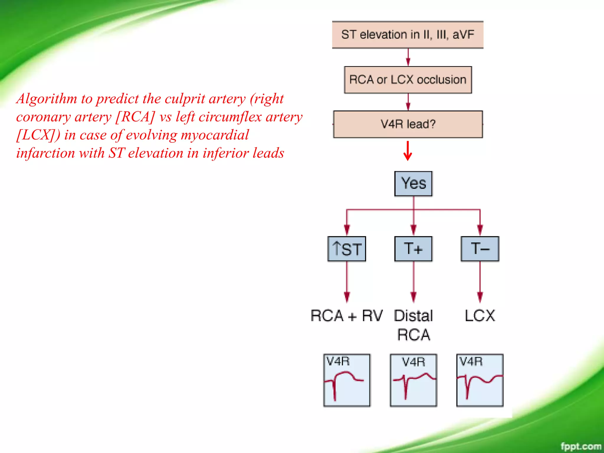 Algorithm to predict the culprit artery (right
coronary artery [RCA] vs left circumflex artery
[LCX]) in case of evolving myocardial
infarction with ST elevation in inferior leads
 
