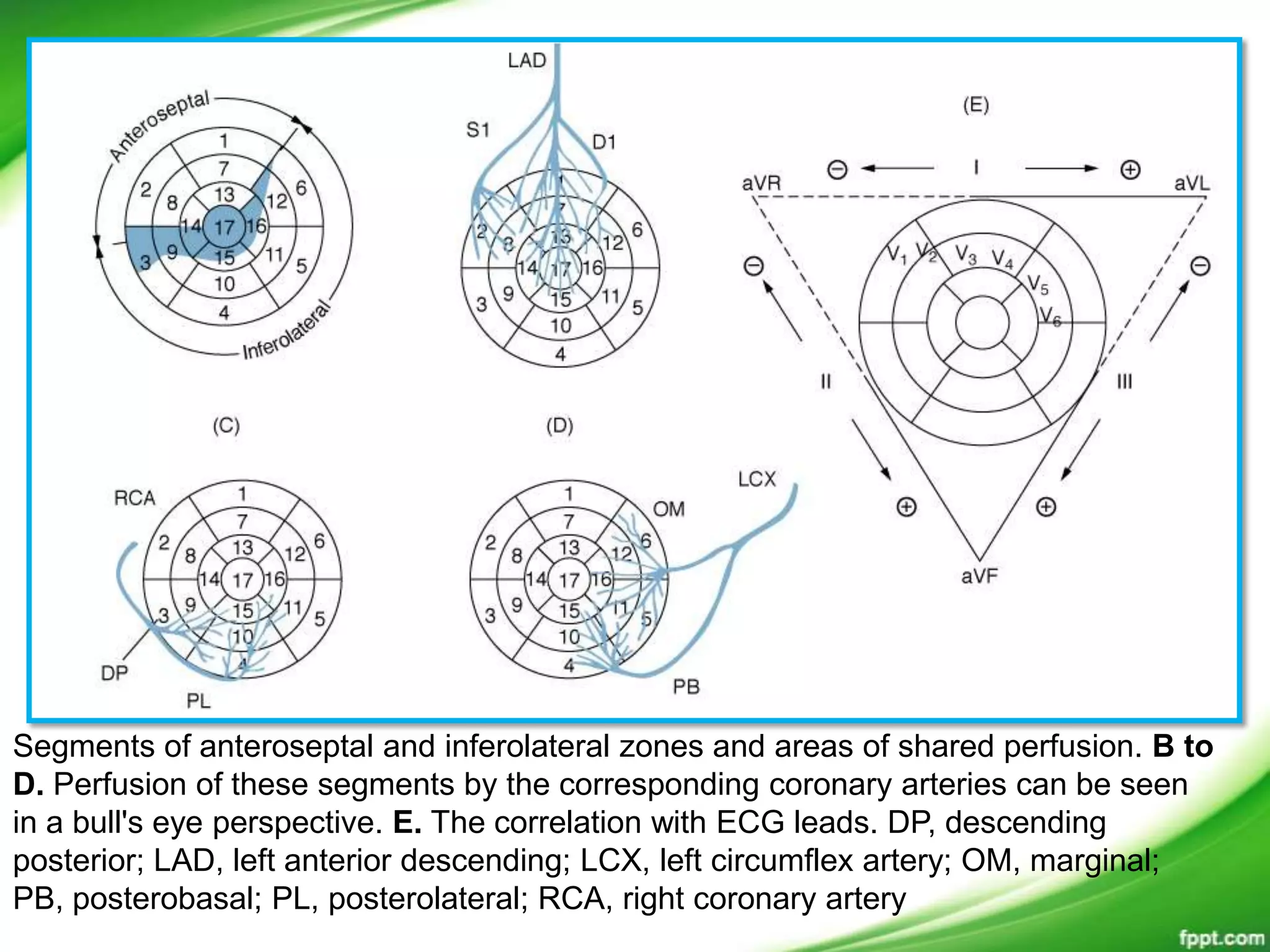 Segments of anteroseptal and inferolateral zones and areas of shared perfusion. B to
D. Perfusion of these segments by the corresponding coronary arteries can be seen
in a bull's eye perspective. E. The correlation with ECG leads. DP, descending
posterior; LAD, left anterior descending; LCX, left circumflex artery; OM, marginal;
PB, posterobasal; PL, posterolateral; RCA, right coronary artery
 