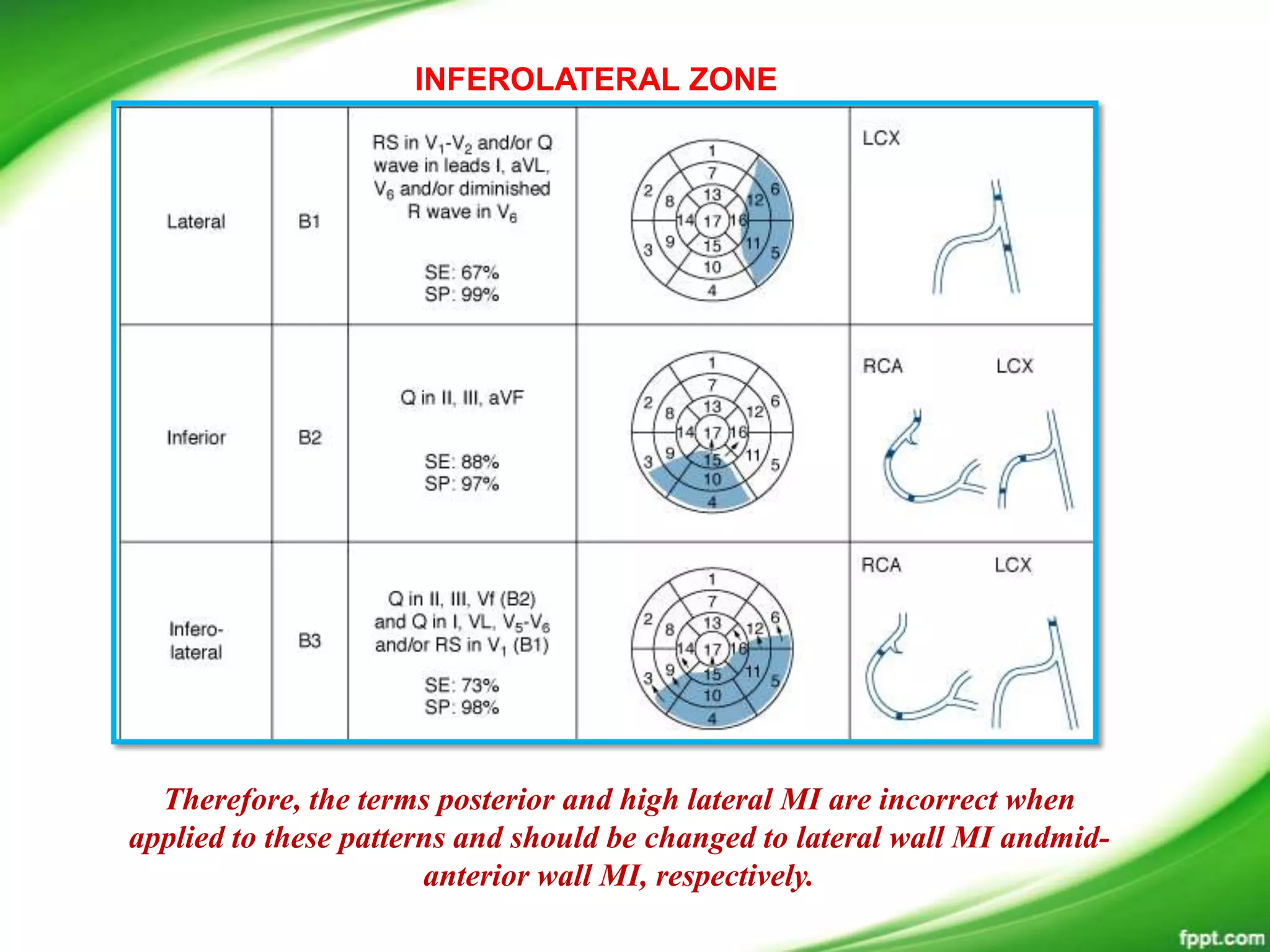 INFEROLATERAL ZONE
Therefore, the terms posterior and high lateral MI are incorrect when
applied to these patterns and should be changed to lateral wall MI andmid-
anterior wall MI, respectively.
 
