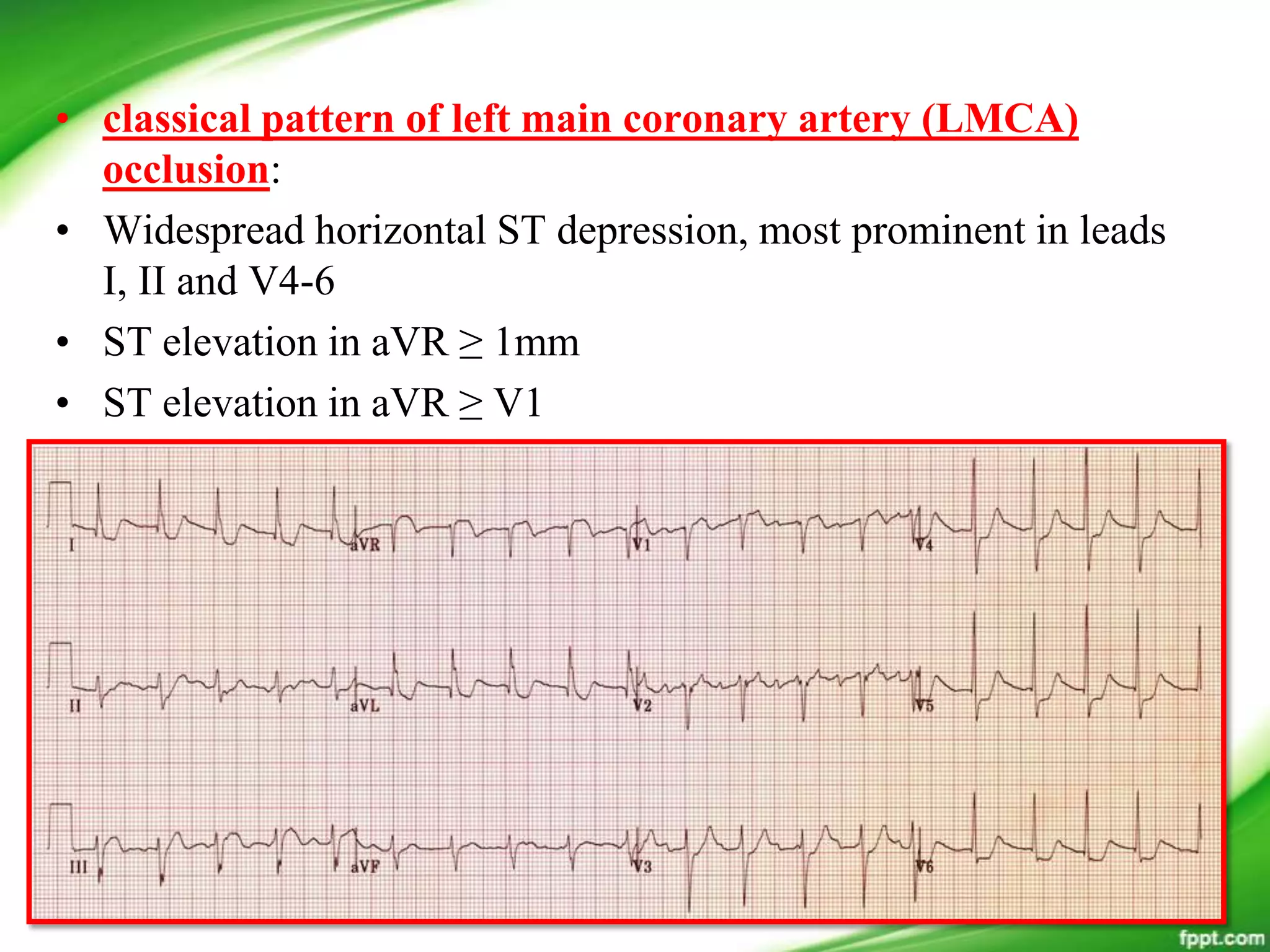 • classical pattern of left main coronary artery (LMCA)
occlusion:
• Widespread horizontal ST depression, most prominent in leads
I, II and V4-6
• ST elevation in aVR ≥ 1mm
• ST elevation in aVR ≥ V1
 