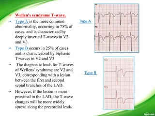 • Wellen's syndrome T-wave.
• Type A is the more common
abnormality, occurring in 75% of
cases, and is characterized by
deeply inverted T-waves in V2
and V3.
• Type B occurs in 25% of cases
and is characterized by biphasic
T-waves in V2 and V3
• The diagnostic leads for T-waves
of Wellens' syndrome are V2 and
V3, corresponding with a lesion
between the first and second
septal branches of the LAD.
• However, if the lesion is more
proximal in the LAD, the T-wave
changes will be more widely
spread along the precordial leads.
Type A
Type B
 