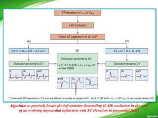 Algorithm to precisely locate the left anterior descending (LAD) occlusion in the case
of an evolving myocardial infarction with ST elevation in precordial leads
 