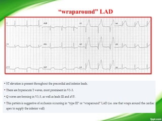 “wraparound” LAD
 