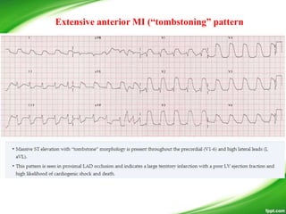 Extensive anterior MI (“tombstoning” pattern
 