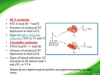 • RCA occlusion
• STE in lead III > lead II
• Presence of reciprocal ST
depression in lead I,aVL
• Signs of right ventricular
infarction: STE in V1 and V4R
• Circumflex occlusion
• STEin lead II =/> lead III
• Absence of reciprocal ST
depression in lead I,aVL
• Signs of lateral infarction: ST
elevation in the lateral leads I
and aVL or V5-6
Relative Q-wave depth in leads II and III is not useful in determining the culprit
artery.
 