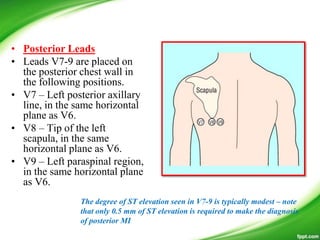 • Posterior Leads
• Leads V7-9 are placed on
the posterior chest wall in
the following positions.
• V7 – Left posterior axillary
line, in the same horizontal
plane as V6.
• V8 – Tip of the left
scapula, in the same
horizontal plane as V6.
• V9 – Left paraspinal region,
in the same horizontal plane
as V6.
The degree of ST elevation seen in V7-9 is typically modest – note
that only 0.5 mm of ST elevation is required to make the diagnosis
of posterior MI
 