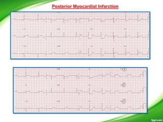 Posterior Myocardial Infarction
 