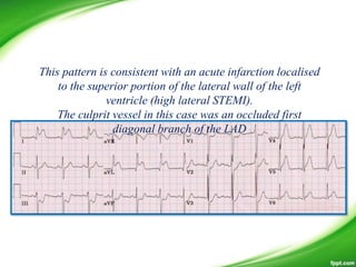 This pattern is consistent with an acute infarction localised
to the superior portion of the lateral wall of the left
ventricle (high lateral STEMI).
The culprit vessel in this case was an occluded first
diagonal branch of the LAD
 