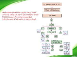 Algorithm to predict the culprit artery (right
coronary artery [RCA] vs left circumflex artery
[LCX]) in case of evolving myocardial
infarction with ST elevation in inferior leads
 