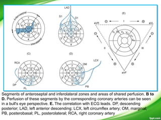 Segments of anteroseptal and inferolateral zones and areas of shared perfusion. B to
D. Perfusion of these segments by the corresponding coronary arteries can be seen
in a bull's eye perspective. E. The correlation with ECG leads. DP, descending
posterior; LAD, left anterior descending; LCX, left circumflex artery; OM, marginal;
PB, posterobasal; PL, posterolateral; RCA, right coronary artery
 