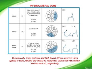 INFEROLATERAL ZONE
Therefore, the terms posterior and high lateral MI are incorrect when
applied to these patterns and should be changed to lateral wall MI andmid-
anterior wall MI, respectively.
 