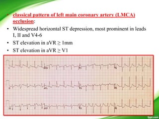 • classical pattern of left main coronary artery (LMCA)
occlusion:
• Widespread horizontal ST depression, most prominent in leads
I, II and V4-6
• ST elevation in aVR ≥ 1mm
• ST elevation in aVR ≥ V1
 