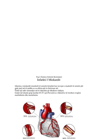 Fig.2 Zemra (Arteriet Koronare) 
Infarkti I Miokardit 
Ishemia e miokardit (muskulit të zemrës) krijohet kur nevojat e muskulit të zemrës për 
gjak janë më të mëdha se sa aftësia për ta furnizuar atë. 
Është një ndër sëmundjet më të shpeshta që shkakton vdekjen. 
Godet më shumë grup moshat 45-55 vjet.Preventiva e faktorëve të rrezikut zvoglon 
morbiditetin dhe mortalitetin. 
 