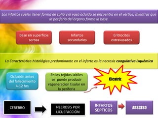 Los infartos suelen tener forma de cuña y el vaso ocluido se encuentra en el vértice, mientras que
                              la periferia del órgano forma la base.



           Base en superficie              Infartos                   Eritrocitos
                serosa                   secundarios                 extravasados




  La Característica histológica predominante en el infarto es la necrosis coagulativa isquémica


     Oclusión antes            En los tejidos labiles
    del fallecimiento           se puede producir                   Cicatriz
         4-12 hrs            regeneracion tisular en
                                    la periferia



                                                           INFARTOS
     CEREBRO                      NECROSIS POR                                      ABSCESO
                                  LICUEFACCIÓN             SEPTICOS
 